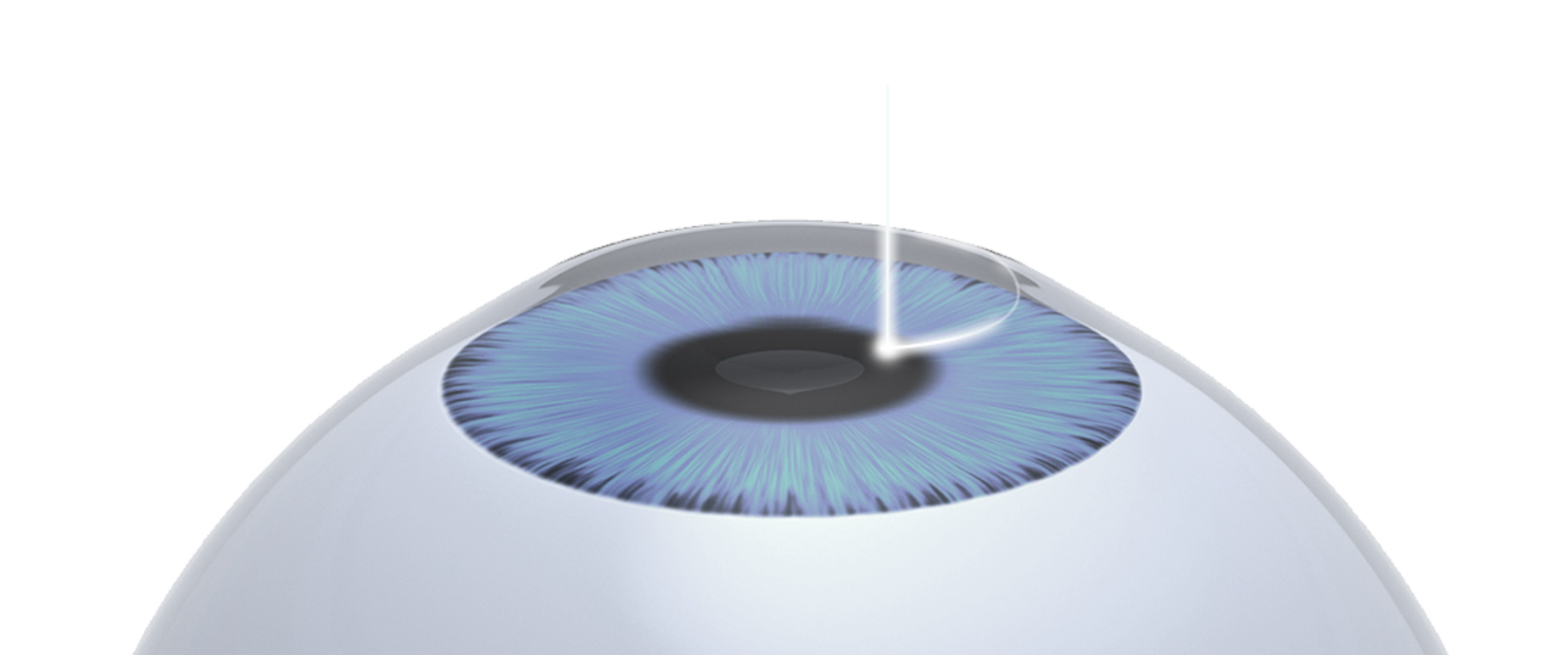 SMILE LASIK 理論說明圖片