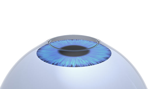 Carefully removing the corneal epithelium in LASEK step 1
