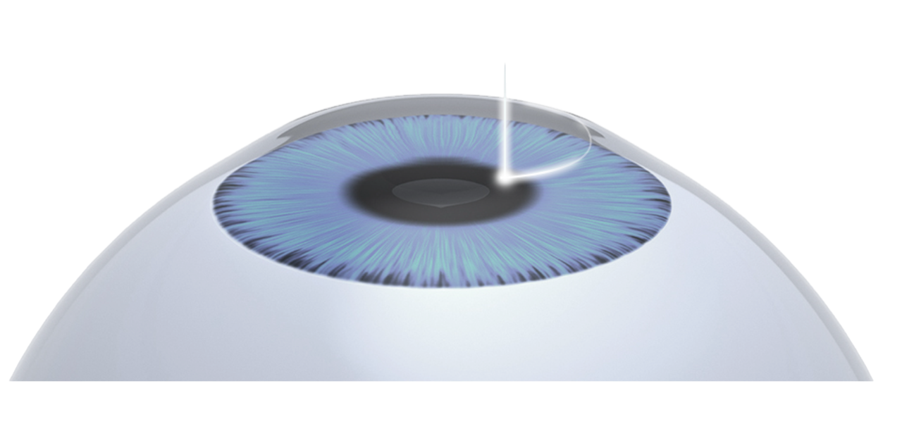 Illustration of the eye showing how LASIK surgery corrects vision