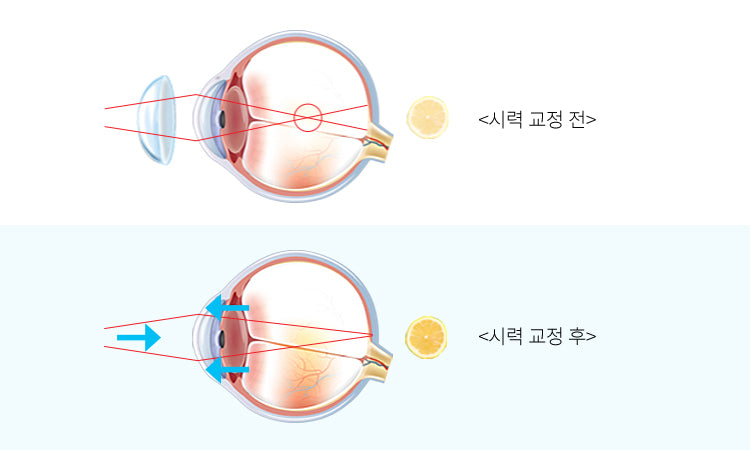 Before and after vision correction using PREMIER TORIC lenses